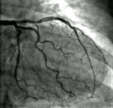 آنژیوگرافی قلب یا کرونر