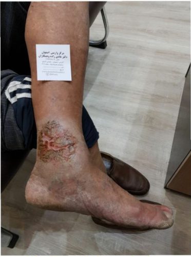 What are varicose veins