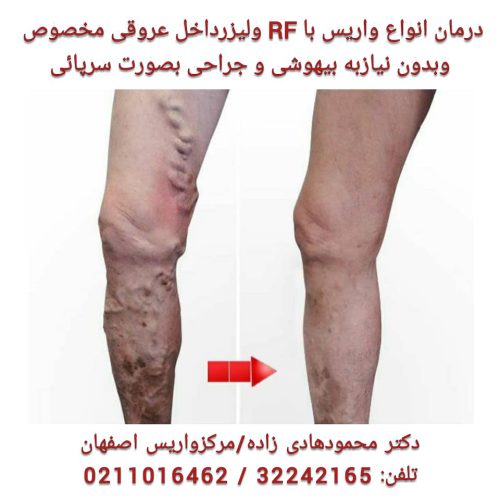 علاج الدوالي بالليزر